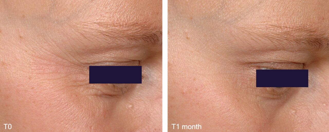 OptimHyal01